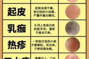 一岁宝宝湿疹怎么办_湿疹反复怎么护理