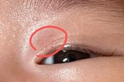 宝宝眼睛有红点怎么办_新生儿眼白红点原因