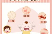 5个月宝宝脸上起红疹怎么办_婴儿湿疹护理方法