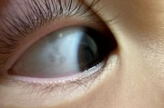 三岁宝宝眼白上有黑斑_需要看医生吗