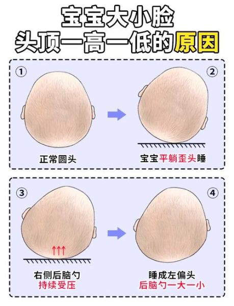 宝宝南北头图片_怎么判断偏头程度