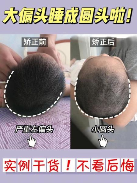 宝宝南北头图片_怎么判断偏头程度