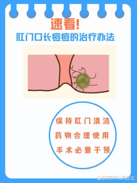 宝宝肛门小疙瘩是什么_宝宝肛门小疙瘩怎么办