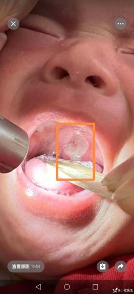 四个月宝宝口腔溃疡图_怎么快速缓解