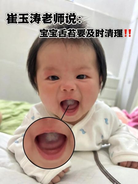 两个月宝宝爱吐舌头正常吗_需要看医生吗