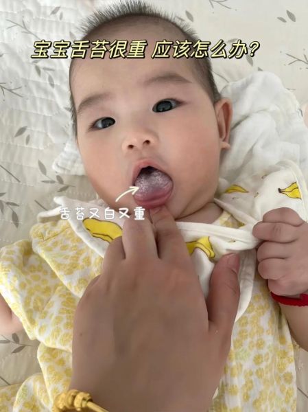 两个月宝宝爱吐舌头正常吗_需要看医生吗