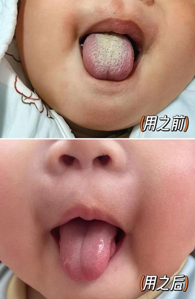 宝宝舌苔厚白怎么回事_怎么处理