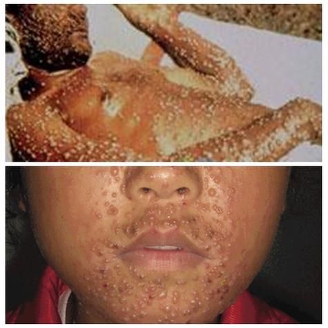 天花图片大全_天花早期症状图片对比