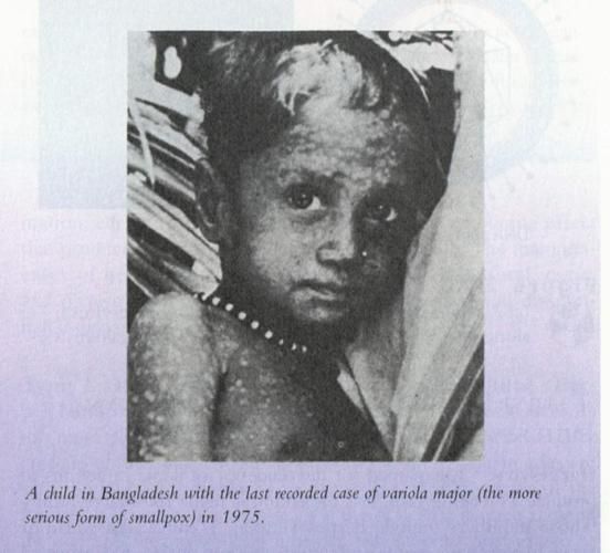 天花图片大全_天花早期症状图片对比