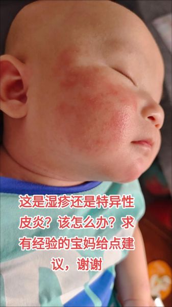 母乳会引起宝宝湿疹吗_湿疹宝宝还能继续母乳吗