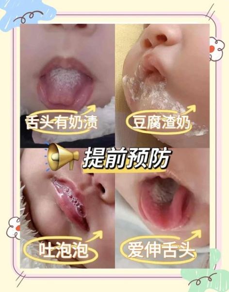 新生宝宝吐奶像豆腐渣怎么回事_需要看医生吗