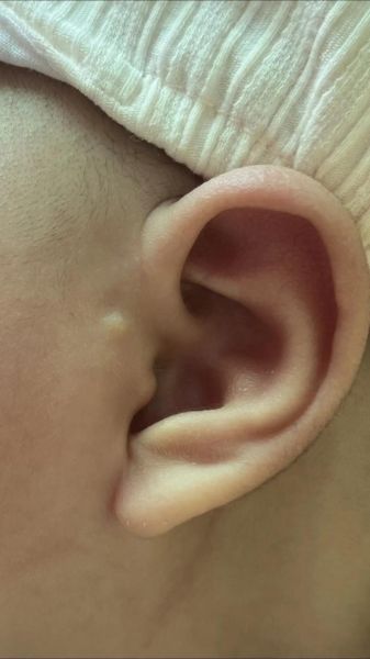 宝宝附耳切除最佳年龄_附耳手术费用大概多少钱