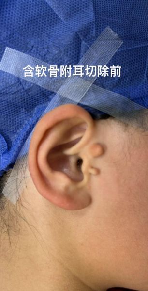 宝宝附耳切除最佳年龄_附耳手术费用大概多少钱