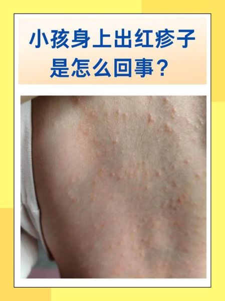 宝宝热痱子症状图片_怎么快速消退
