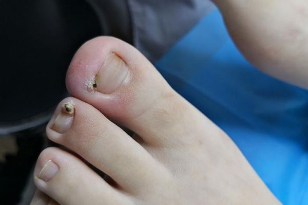 宝宝甲沟炎化脓怎么办_甲沟炎化脓能自愈吗