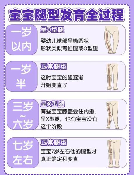 14个月宝宝o型腿图片_正常还是缺钙