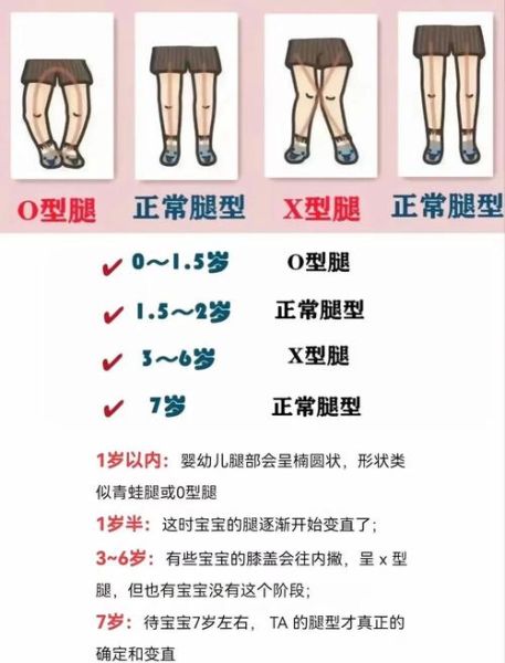 14个月宝宝o型腿图片_正常还是缺钙