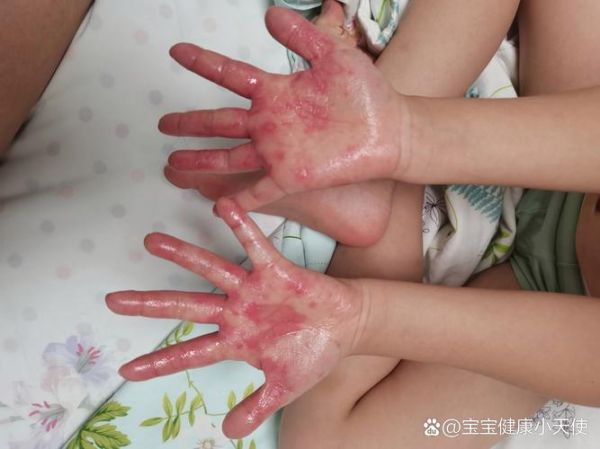 五岁宝宝手上长水泡怎么办_会不会传染