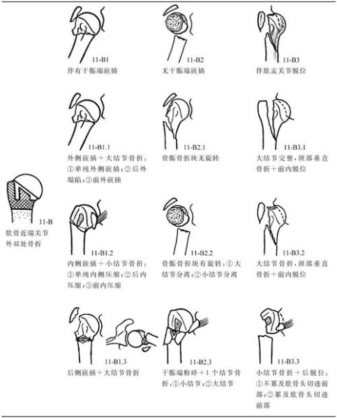 骨折图片大全_骨折类型有哪些
