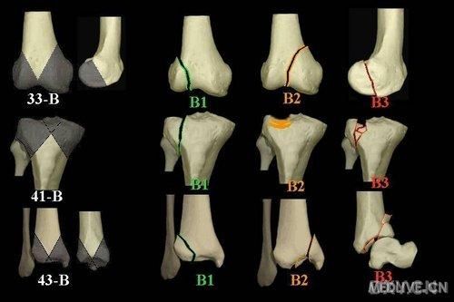 骨折图片大全_骨折类型有哪些