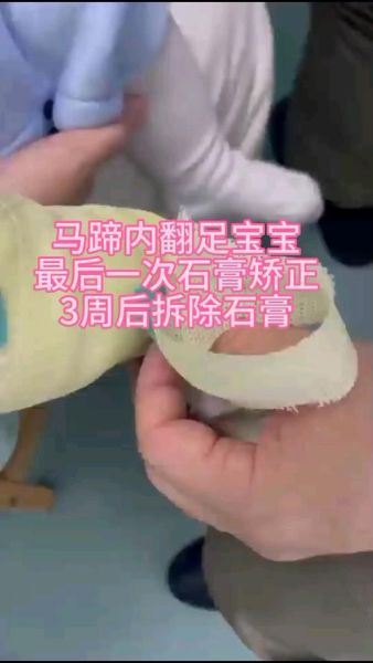 宝宝右脚内翻怎么办_矫正方法有哪些