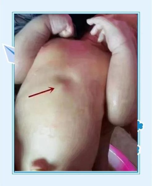 宝宝剑突突出正常吗_新生儿剑突骨图片怎么看