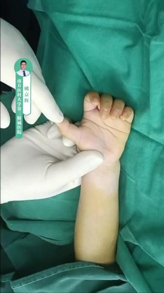 宝宝大拇指伸不直_需要看医生吗