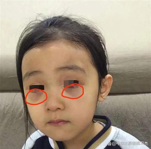 宝宝眼角发青怎么回事_宝宝眼角发青正常吗