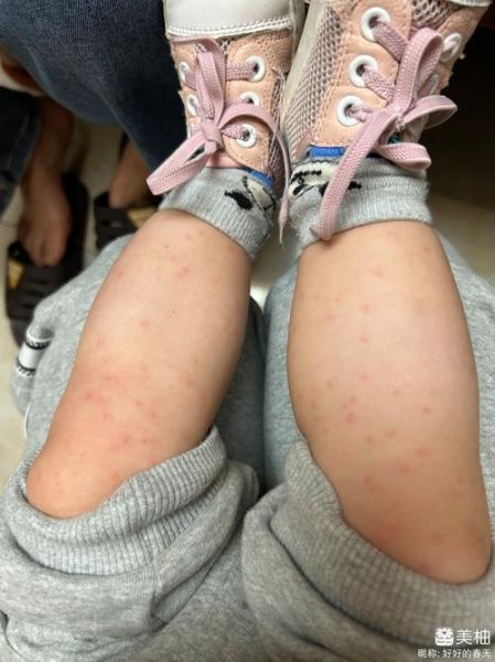 宝宝大腿外侧起红疹子怎么办_婴儿大腿外侧红疹子原因