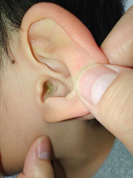 宝宝怎么掏耳屎_婴儿耳屎清理正确方法