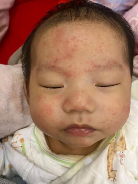 宝宝嘴巴周围长湿疹怎么办_婴儿口周湿疹怎么护理