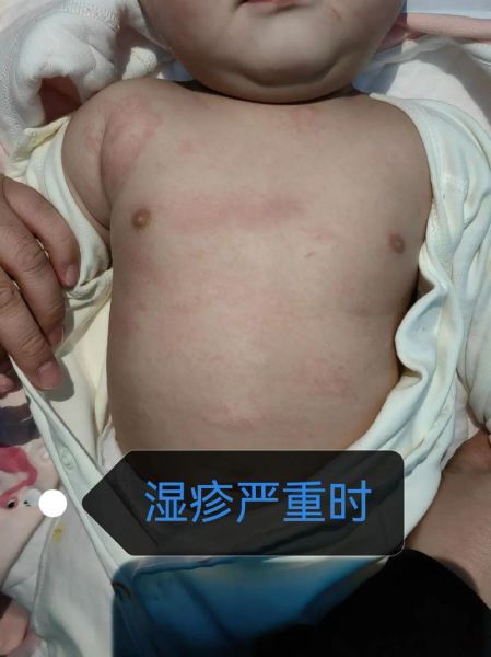 宝宝湿疹怎么查过敏源_湿疹反复查什么项目