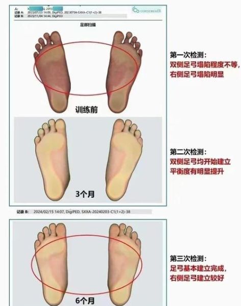 三个月宝宝脚往外撇正常吗_怎么矫正