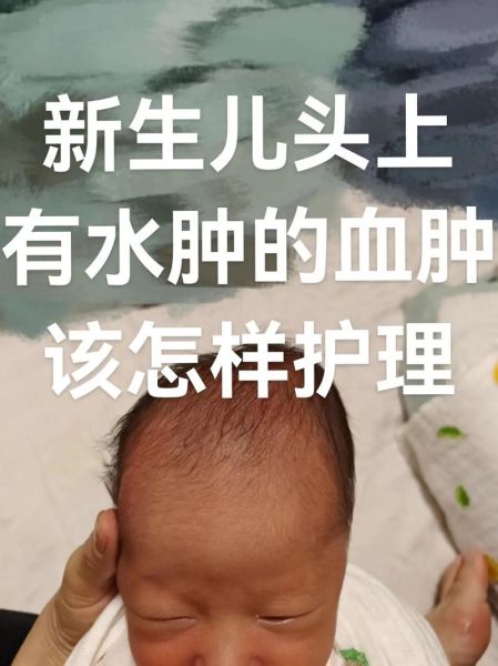 宝宝头皮血肿多久能消_需要抽吸吗