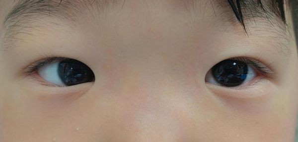 宝宝对眼怎么判断_婴儿对眼正常吗