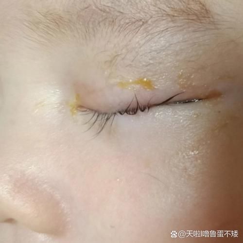 宝宝眼睛睁不开怎么回事_新生儿眼屎多怎么办