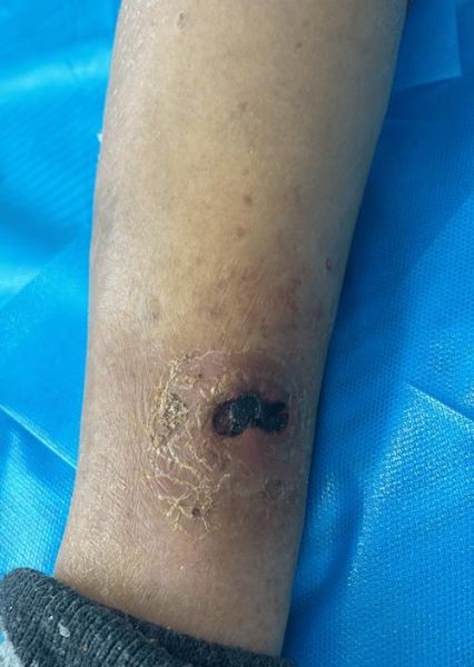 伤口图片大全_如何辨别伤口严重程度