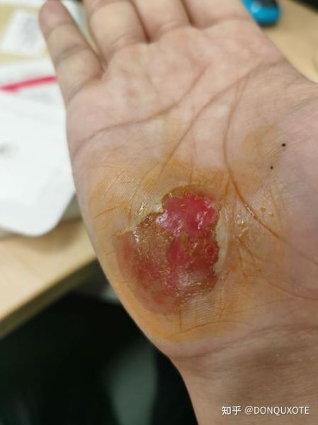 伤口图片大全_如何辨别伤口严重程度