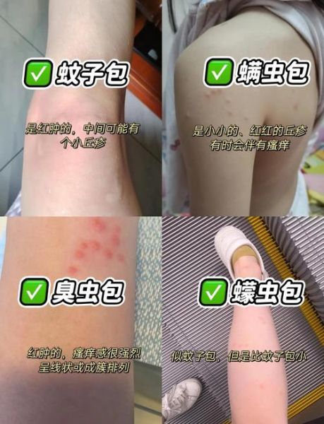 梦到虫子咬是什么预兆_梦见虫子咬自己怎么办