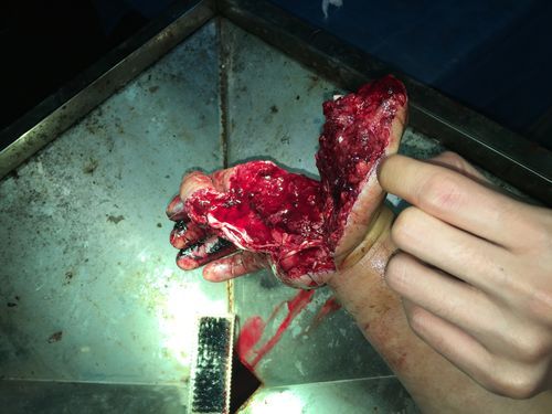 梦到手断了_梦见手断了是什么意思