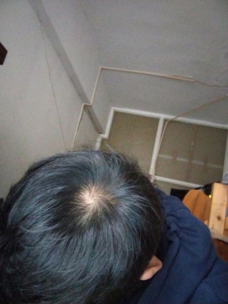 秃顶图片大全_秃顶怎么办