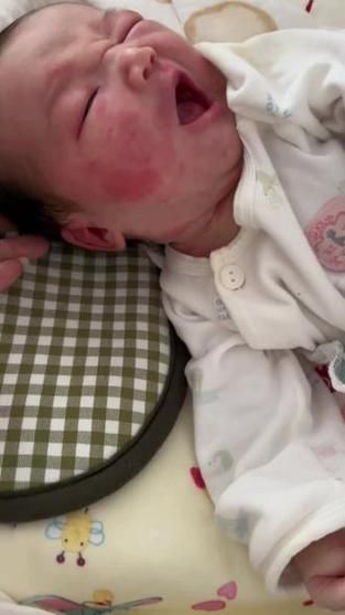 宝宝脸上红斑怎么回事_新生儿红斑多久能好