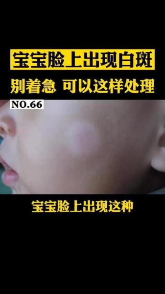 宝宝脸上白块是什么_需要看医生吗