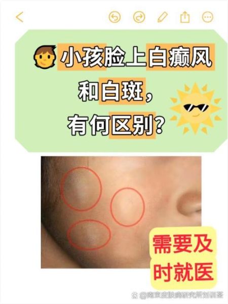 宝宝脸上白块是什么_需要看医生吗