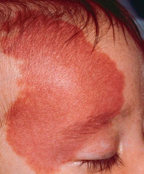 宝宝红色胎记会消退吗_红色胎记需要治疗吗