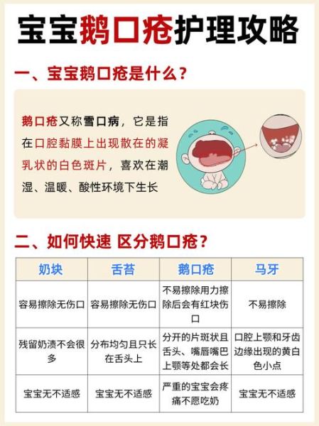 宝宝鹅口疮怎么办_鹅口疮反复发作怎么处理