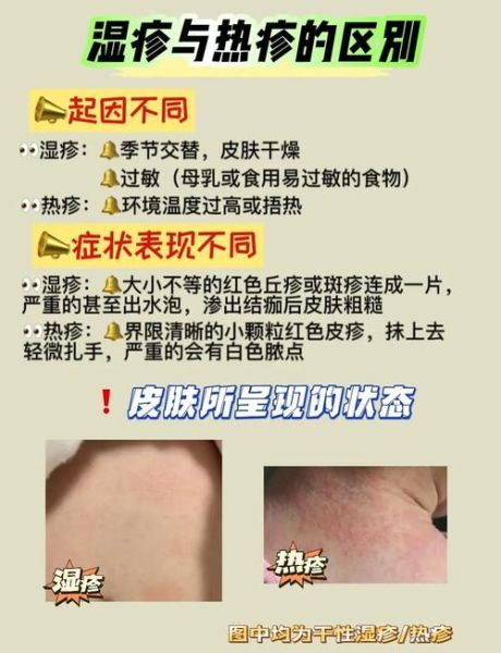 六个月宝宝湿疹怎么办_婴儿湿疹护理方法