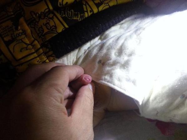 宝宝尿口有点红怎么办_宝宝尿道口红肿原因