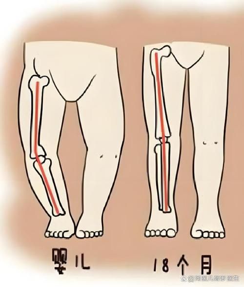 宝宝罗圈腿怎么判别_罗圈腿和正常腿的区别