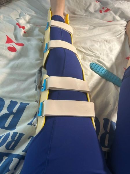 梦到骨折是什么意思_梦见骨折预示什么